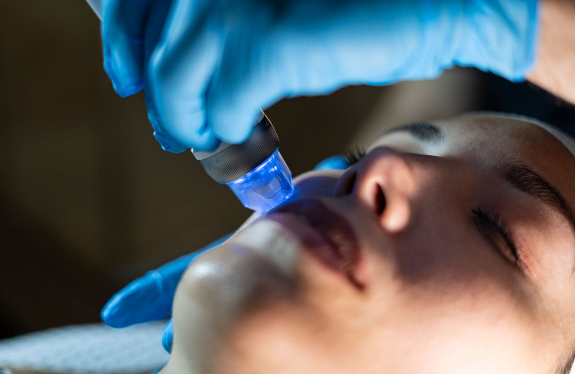 Tratamientos: ALATO MICRONEEDLING RF/ DERMAPEN Tratamientos: ALATO MICRONEEDLING RF/ DERMAPEN