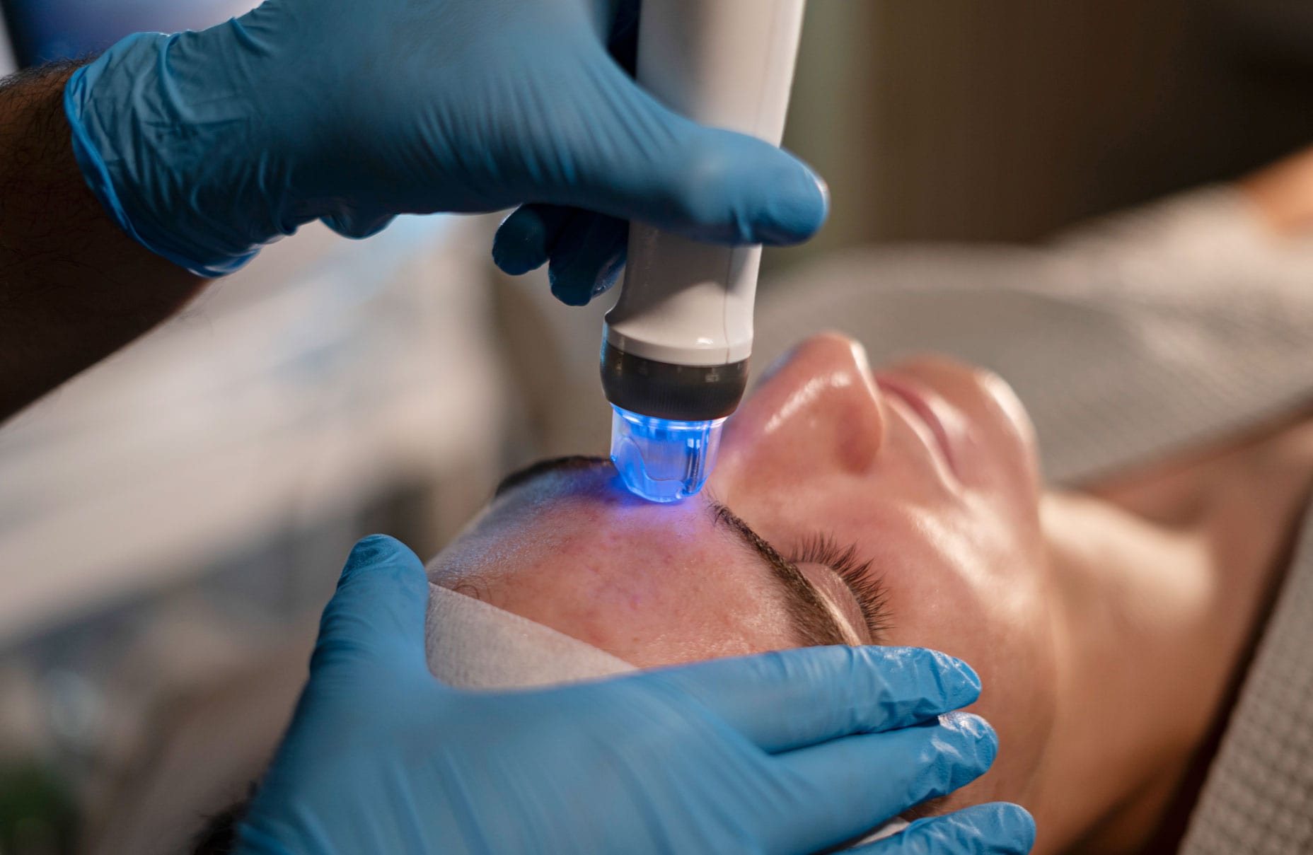 Tratamientos: ALATO MICRONEEDLING RF/ DERMAPEN-2 Tratamientos: ALATO MICRONEEDLING RF/ DERMAPEN-2