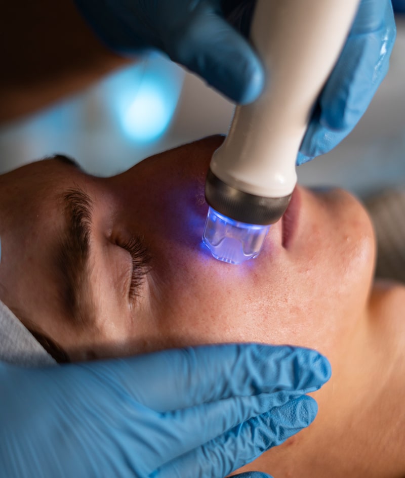Tratamientos: ALATO MICRONEEDLING RF/ DERMAPEN-4 Tratamientos: ALATO MICRONEEDLING RF/ DERMAPEN-4